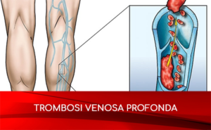 Scopri di più sull'articolo Trombosi venosa profonda